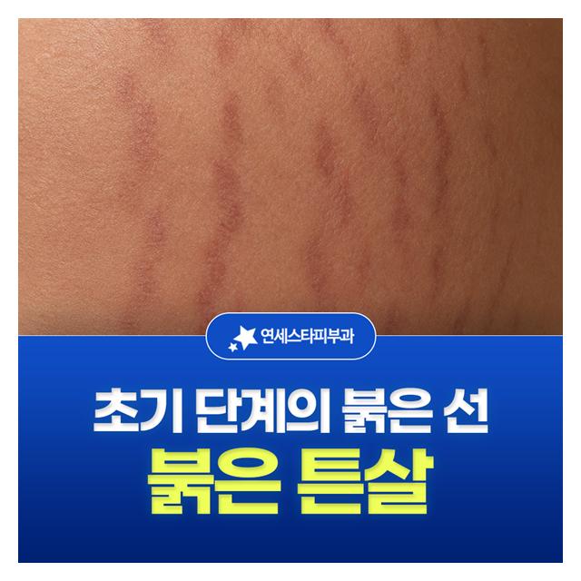 붉은 튼살, 초기 단계의 붉은 선은 비교적 높은 치료효과를 기대합니다