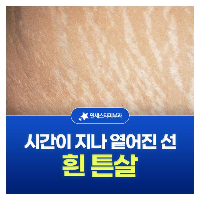 흰 튼살, 시간이 지나 옅어진 선도 효과적으로 개선할 수 있습니다